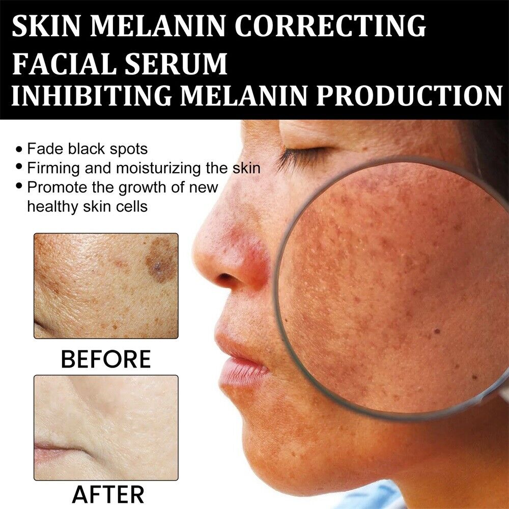 (⏰Limited time discount last 30 minutes⏰)✨Fast Dark Spot Remover-AQA™ Melanin Correcting Facial Serum